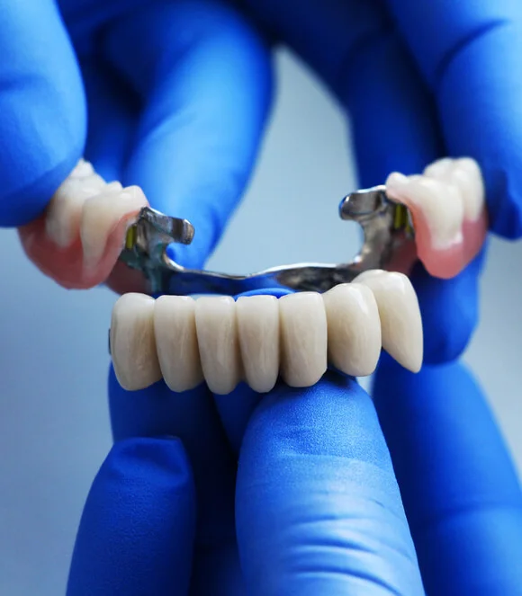 Dental bridge restoration
