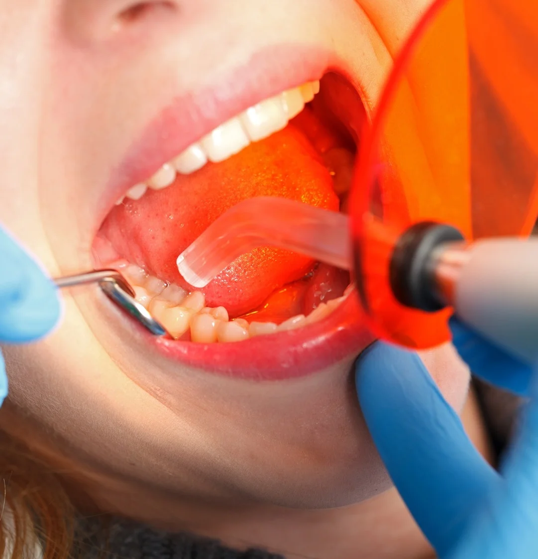 Dental filling treatment in progress