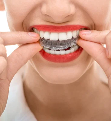 Clear aligner treatment model